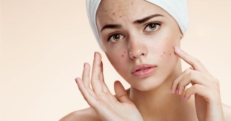 Como Cuidar da Pele Propensa a Acne