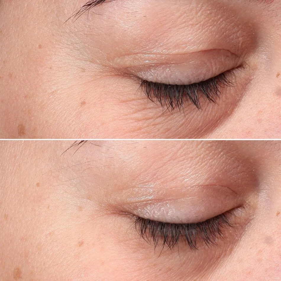 Antes e Depois